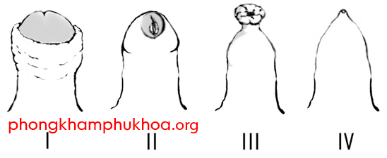 Hẹp bao quy đầu là gì