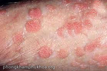 biểu hiện giang mai ở nam giới giai đoạn 2