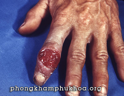 Biểu hiện bệnh giai mai giai đoạn 1 Biểu hiện bệnh giai mai giai đoạn 1
