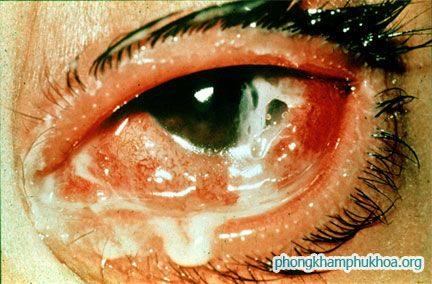 Bệnh lậu ở mắt: Biểu hiện và cách chữa trị
