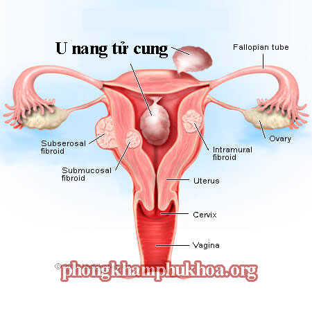 Bệnh u nang tử cung: triệu chứng và cách điều trị