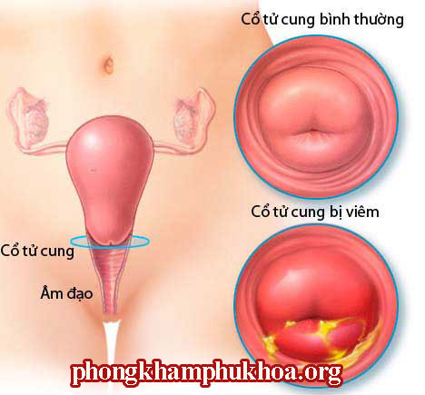 benh-viem-co-tu-cung
