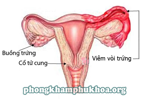 Bệnh viêm vòi trứng ở phụ nữ