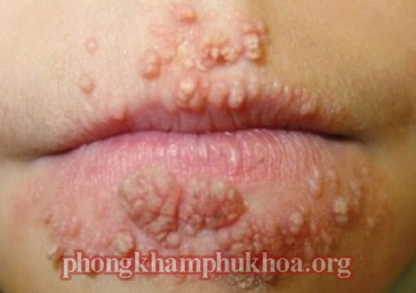 cac-benh-xa-hoi-thuong-gap-3