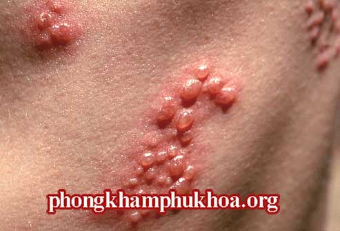 cac-benh-xa-hoi-thuong-gap-4