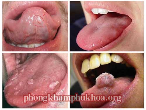 cach-chua-sui-mao-ga-o-mieng