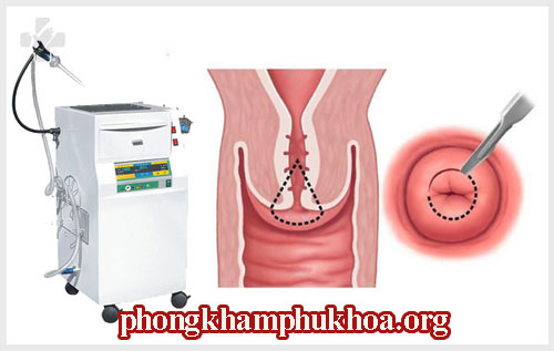 chua-viem-lo-tuyen-co-tu-cung-bang-phuong-phap-dao-leep
