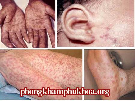 hinh-anh-benh-giang-mai-giai-doan-2