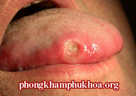 hinh-anh-benh-giang-mai-o-mieng