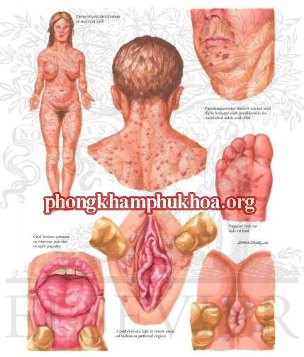 hinh-anh-benh-giang-mai-o-nu-gioi