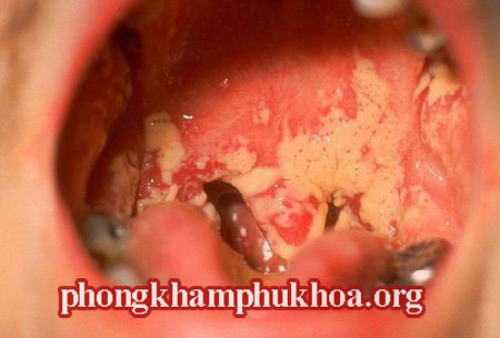 hinh-anh-benh-lau-o-mieng-hong
