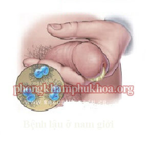 hinh-anh-benh-lau-o-nam-gioi