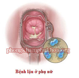 hinh-anh-benh-lau-o-phu-nu