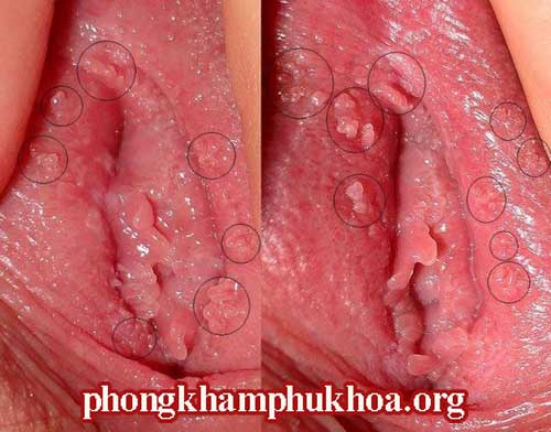 hinh-anh-benh-sui-mao-ga-o-nu-gioi