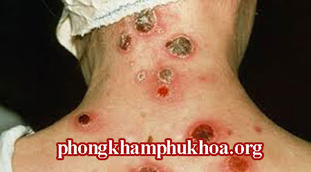 hinh-anh-gom-giang-mai