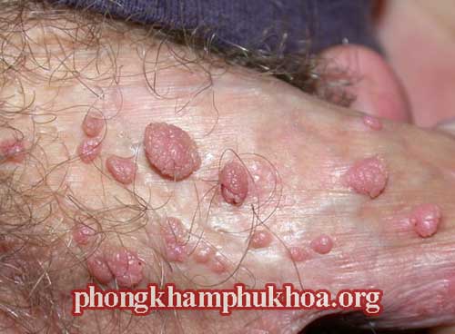 hinh-anh-mun-coc-sinh-duc-o-nam-gioi
