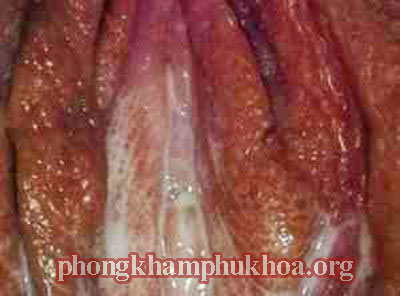 hinh-anh-ve-benh-lau-o-nu-gioi