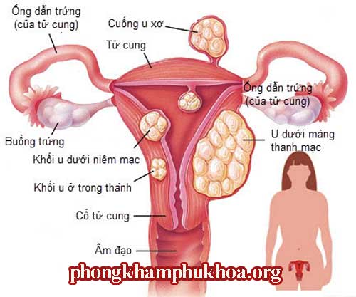 nguyen-nhan-gay-u-xo-co-tu-cung-trieu-chung