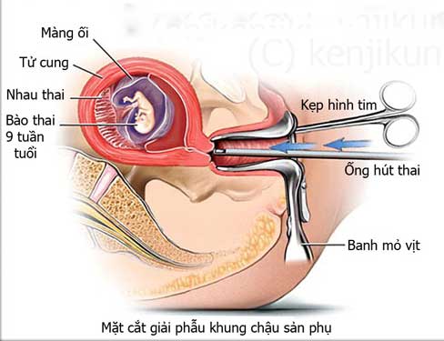 phuong-phap-hut-thai-an-toan