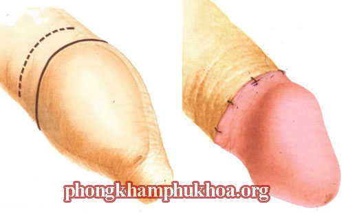 tieu-phau-cat-bao-quy-dau-nhu-the-nao