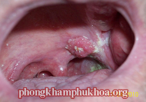 trieu-chung-benh-sui-mao-ga-o-mieng