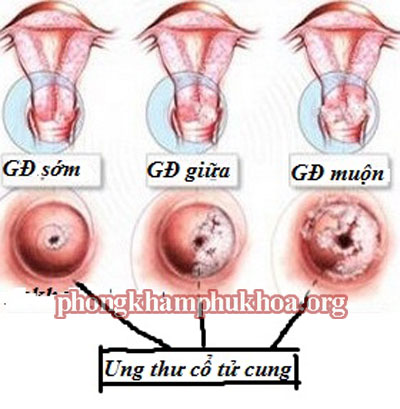 ung-thu-co-tu-cung-co-chua-khoi-duoc-khong