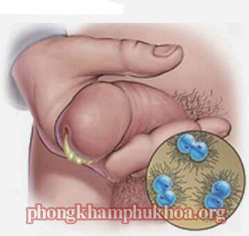 kham-chua-benh-lau-o-dau-tot